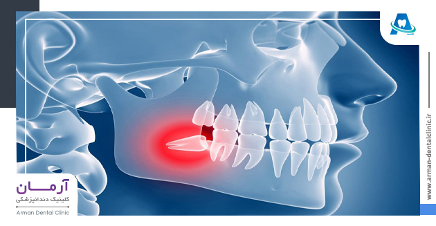 انواع روش های کشیدن دندان عقل