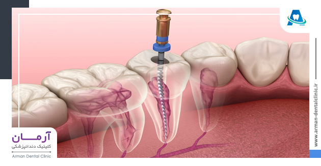 درمان ریشه دندان
