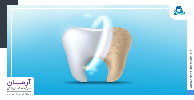 روش های تقویت مینای دندان
