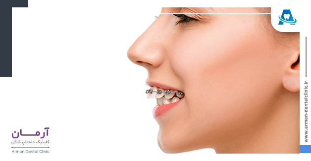 درمان اوربایت دندان