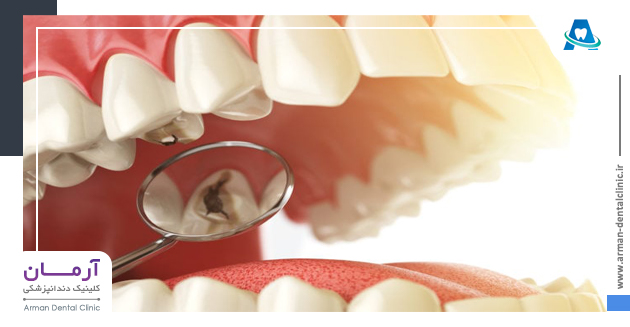 مهم ترین دلایل پوسیدگی دندان