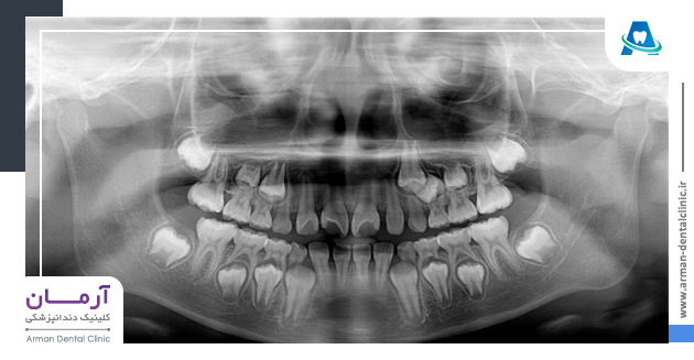 عکس رادیوگرافی دندان