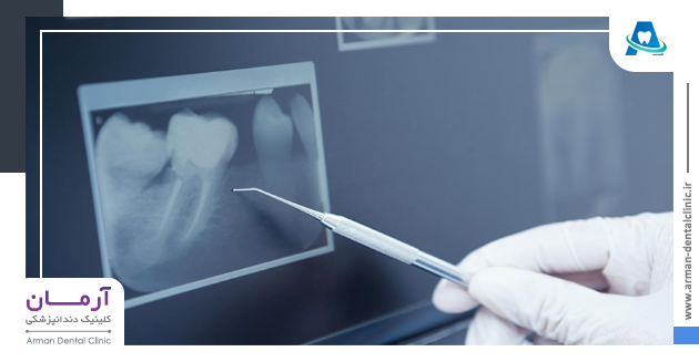 انواع عکس رادیوگرافی دندان