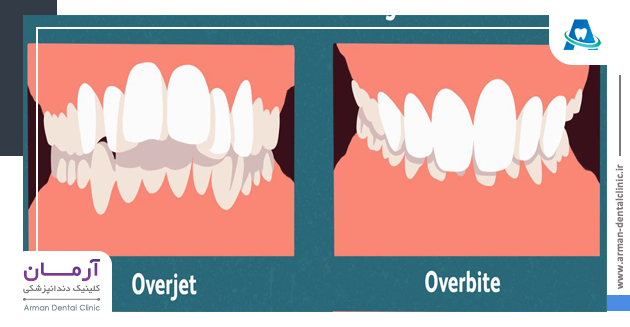 تفاوت اوربایت دندان و اورجت دندان