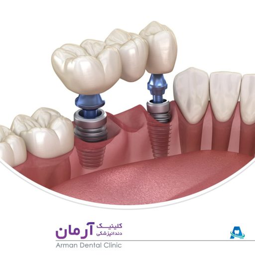 متخصص ایمپلنت و کاشت دندان در شیراز