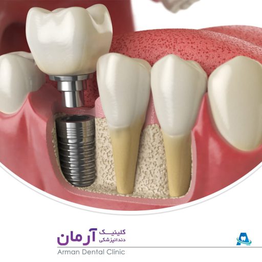 ایمپلنت دندان شیراز