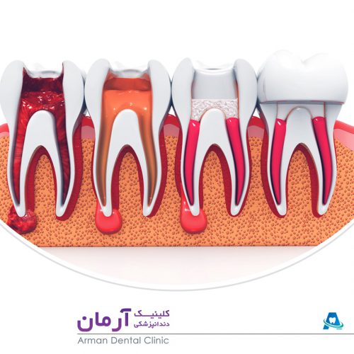 درمان ریشه دندان (عصب کشی)