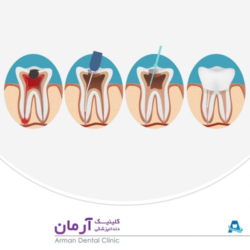 عصب کشی دندان در شیراز